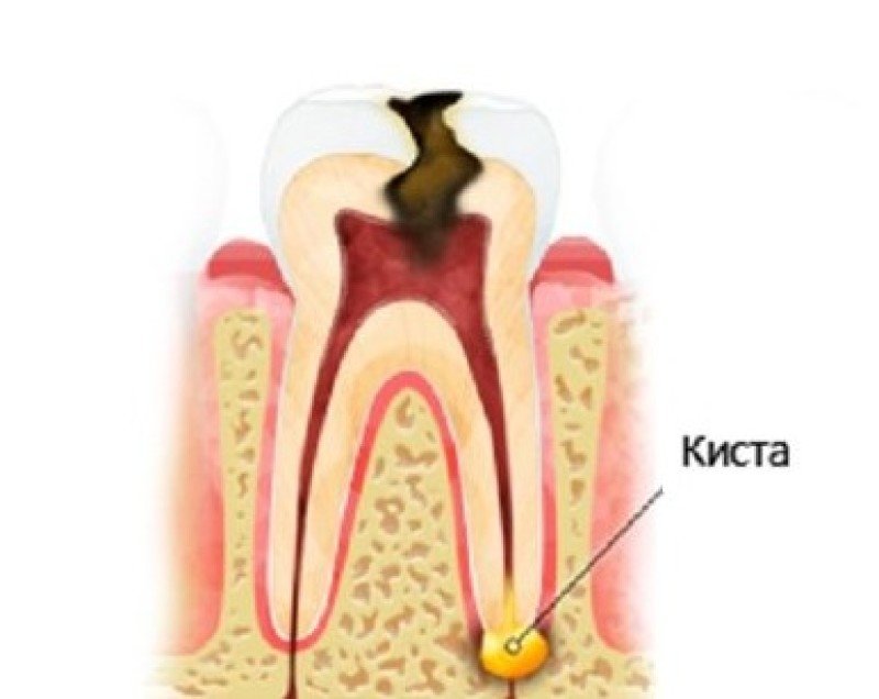 Киста челюсти - 1