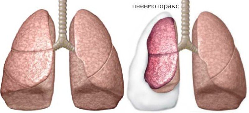 Пневмоторакс - 2