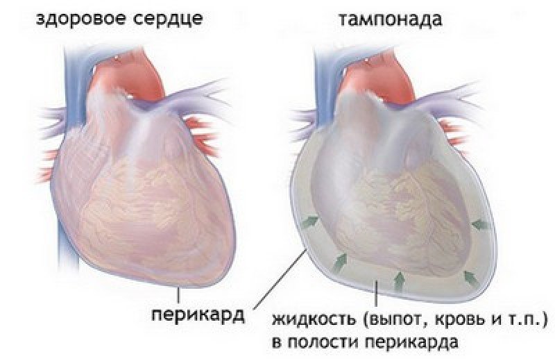 Тампонада сердца - 1
