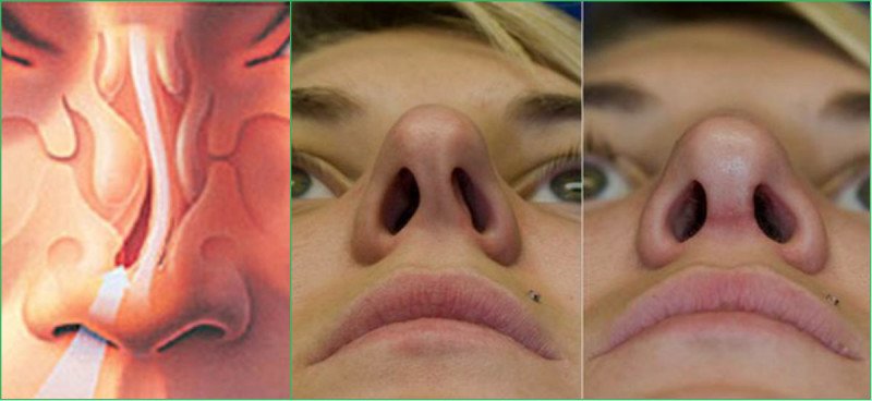 Искривление перегородки носа - 1