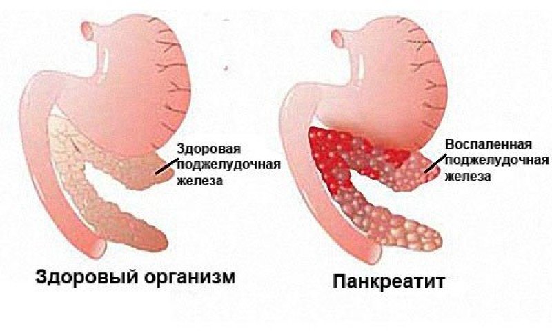 Острый панкреатит - 1