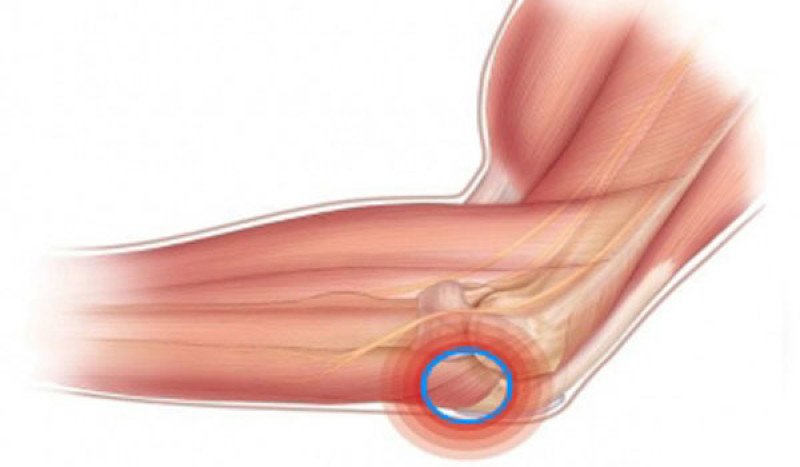 Эпикондилит локтевого сустава - 1