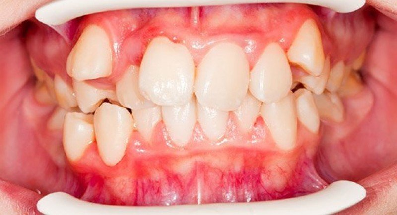 Дистопированный зуб - 1