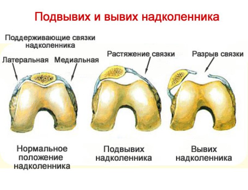 Перелом надколенника карта вызова скорой медицинской