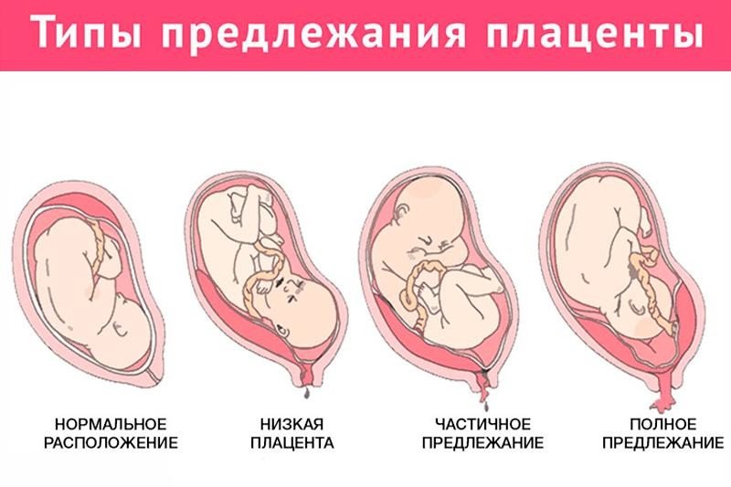 Что такое предлежание плаценты? | Prof. Dr. Selahattin KUMRU