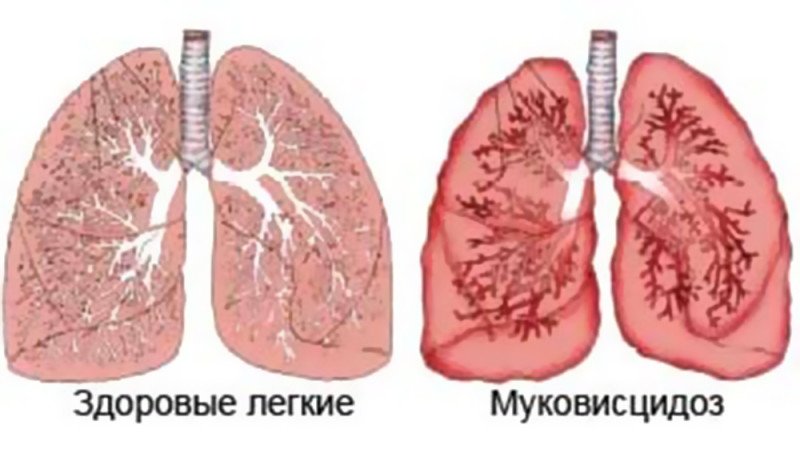 Муковисцидоз - 2