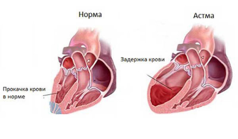 Сердечная астма - 1