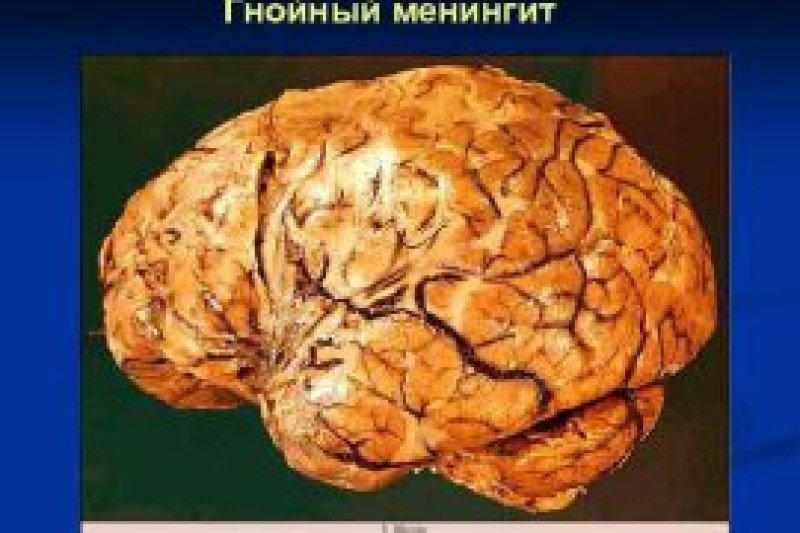 Гнойный менингит - 2