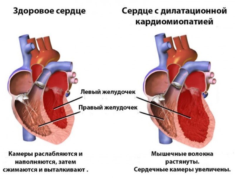 Дилатационная кардиомиопатия - 1