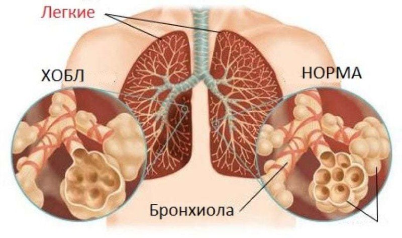 Хроническая обструктивная болезнь легких (хобл) - 2