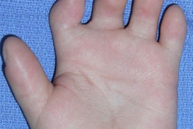 Паронихия пальца на руке: лечение, профилактика
