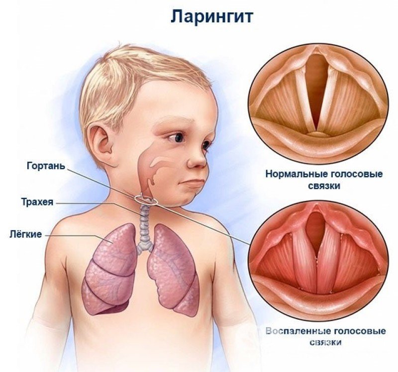 Ларингит у детей: симптомы и лечение