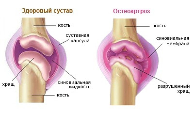 Деформирующий остеоартроз - 1