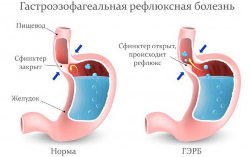 Гастроэзофагеальная рефлюксная болезнь (гэрб) - 1