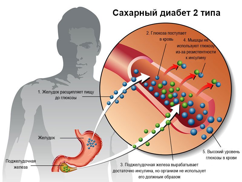 Сахарный диабет ii типа - 2