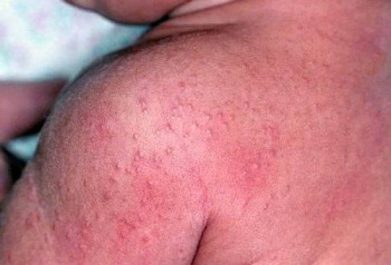 Аллергия или потница: как определить