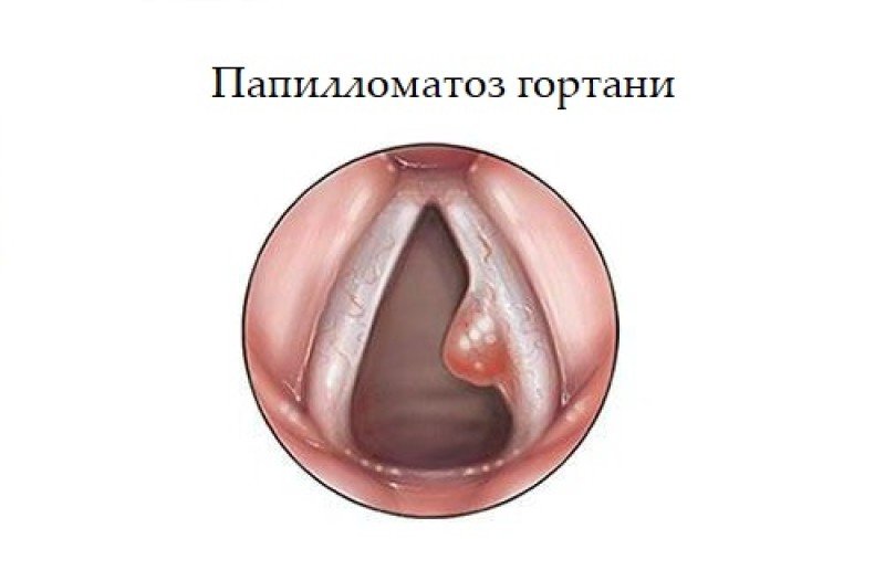 Папилломатоз гортани - 1