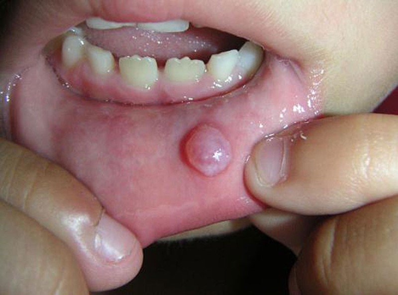 Фиброма полости рта (фпр) - 2