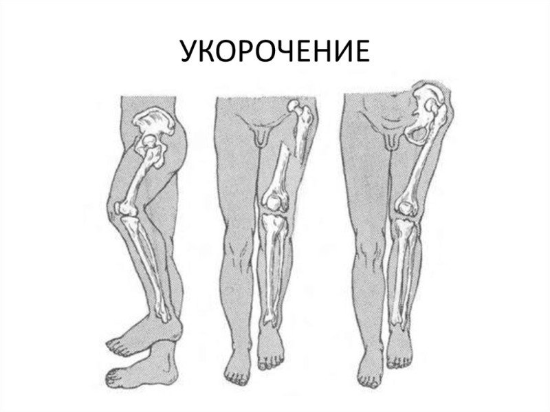 Коррекция разной длины ног