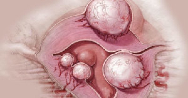 Текалютеиновая киста яичника - 1