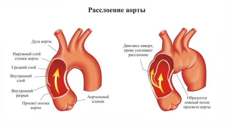 Расслаивающая аневризма аорты - 1