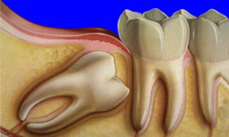 Ретинированный зуб - 1