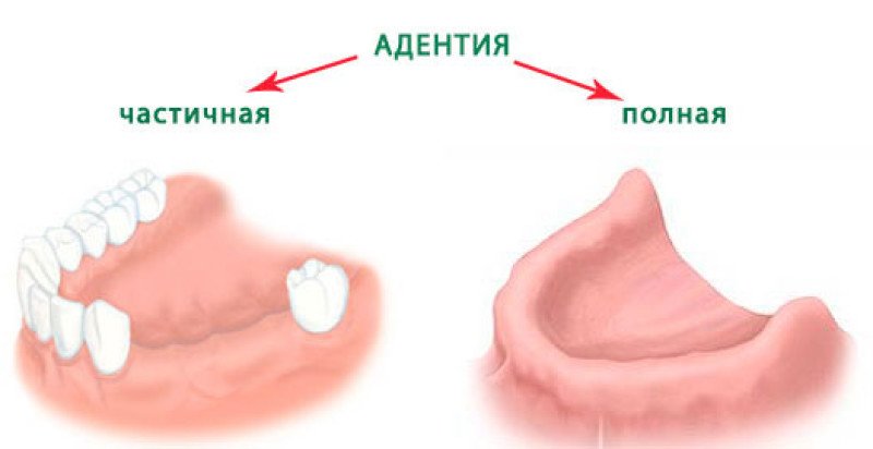 Адентия - 2