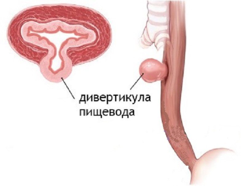 Дивертикулы пищевода - 2