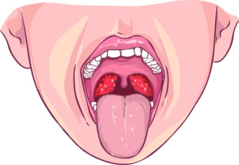 Паратонзиллит - 1