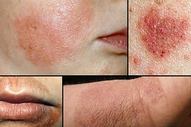 Рак кожи: симптомы