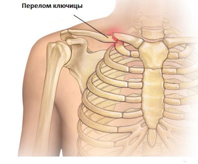 Перелом ключицы - 2