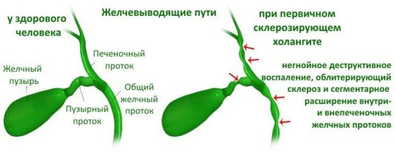 Холангит – причины, симптомы. Методы диагностики лечения различных его видов