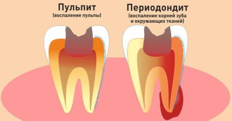 Периодонтит - 1