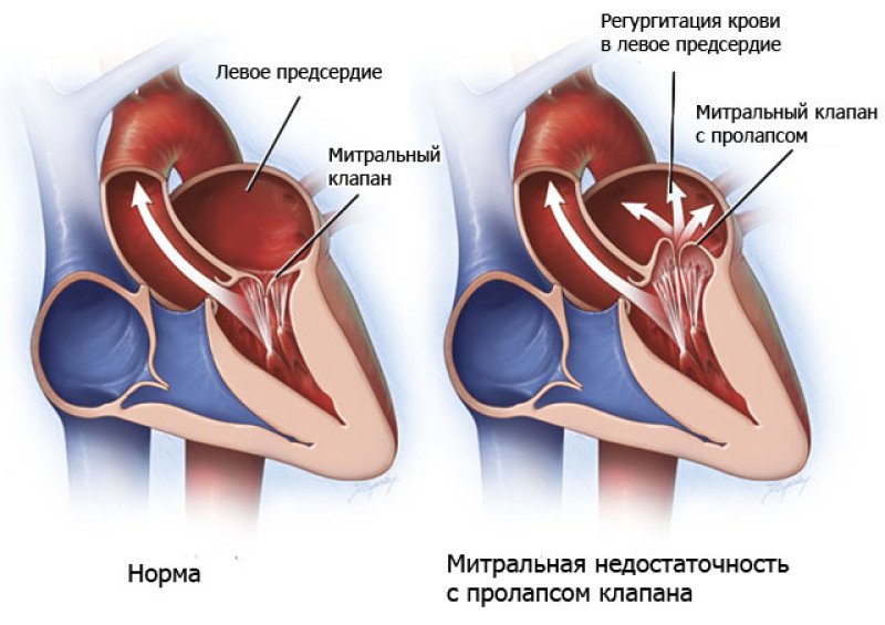 Приобретенный порок сердца - 2