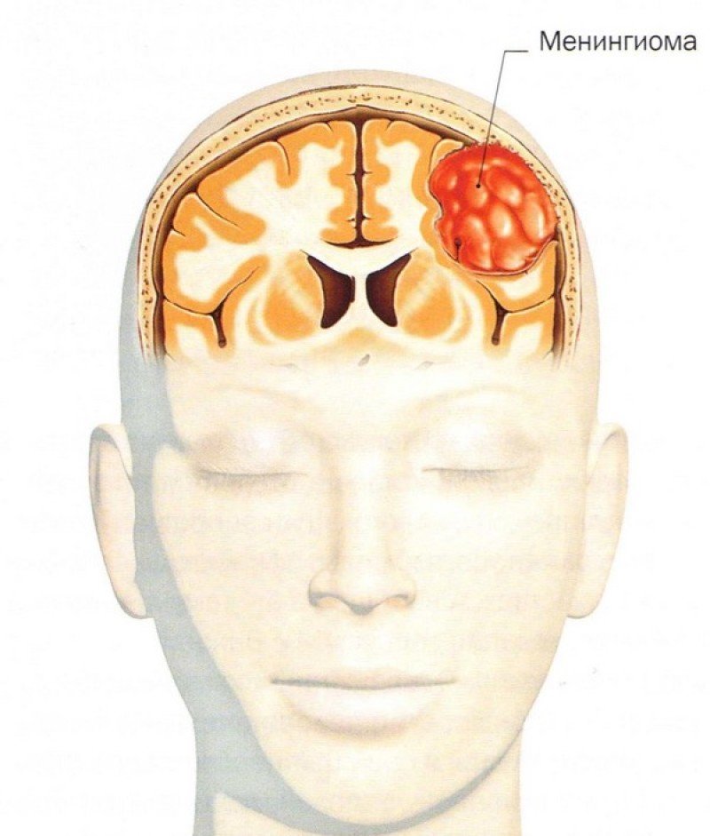 Отекает мозг. Менингиома лобной области. Менинготелиальная менингиома. Менингиома лобной доли. Опухоль головного мозга менингиома.