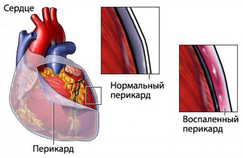 Ревматизм сердца - 1