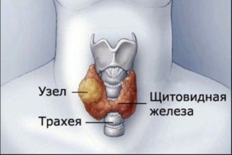 Диффузные изменения щитовидной железы - 2