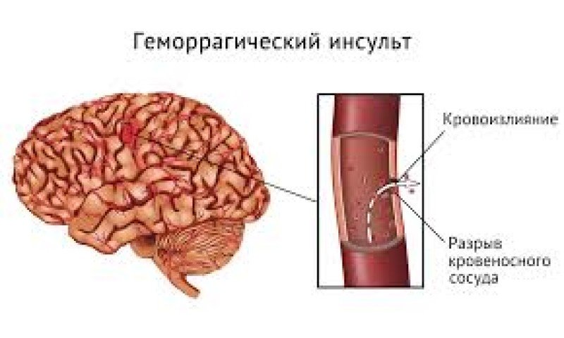 Геморрагический инсульт - 1