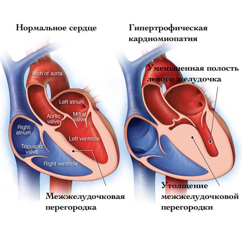 Гипертрофическая кардиомиопатия - 1