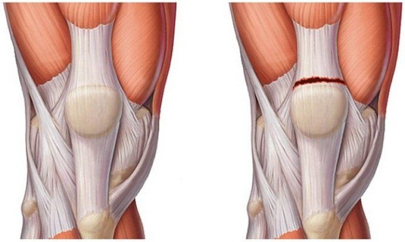 Повреждения связок коленного сустава - 1