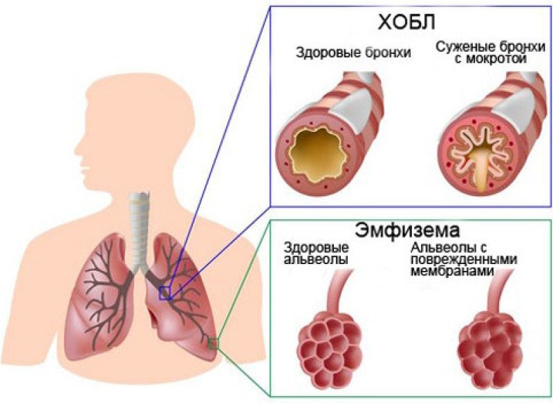 Хроническая обструктивная болезнь легких (хобл) - 1