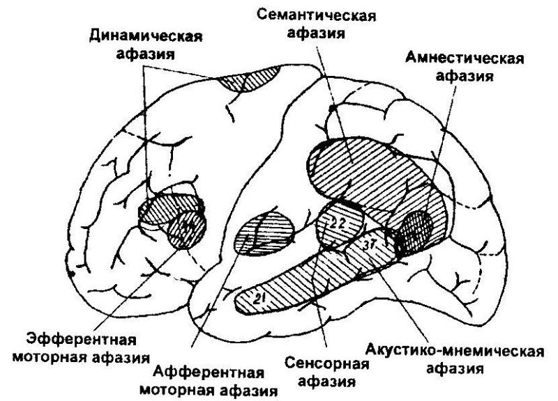 Афазия - 1