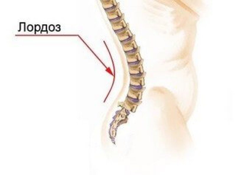 Лордоз - 2