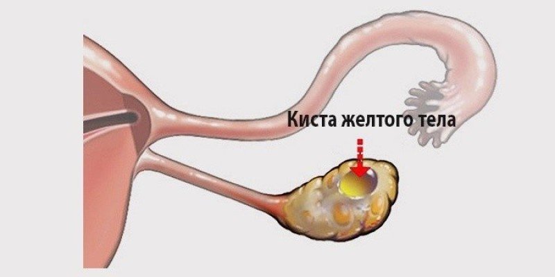 Киста желтого тела яичника