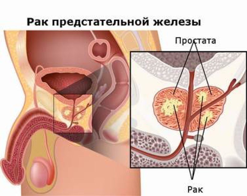 Рак предстательной железы - 1