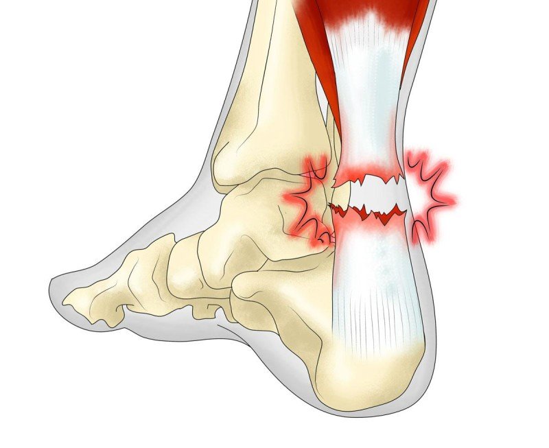 Тендинит ахиллова сухожилия: симптомы, лечение