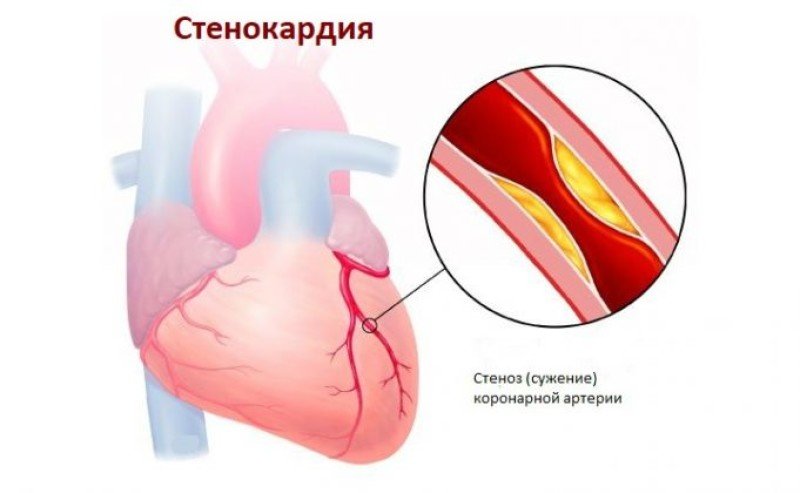 Постинфарктная стенокардия - 2