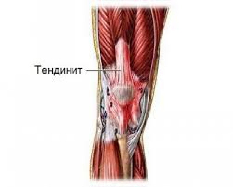 Тендинит коленного сухожилия - 1