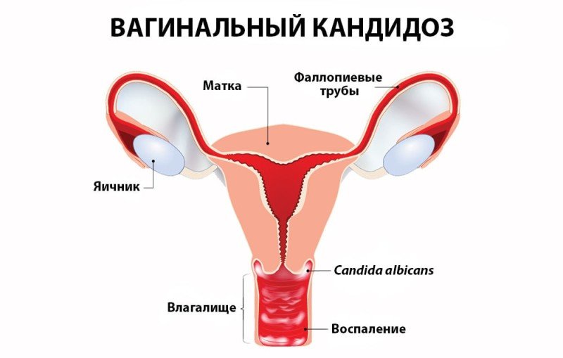 Кандидоз вагинальный («молочница»)