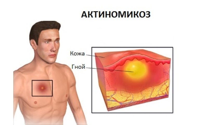 Актиномикоз - 2